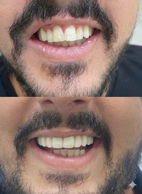 Antes e depois de facetas, paciente da Brivva