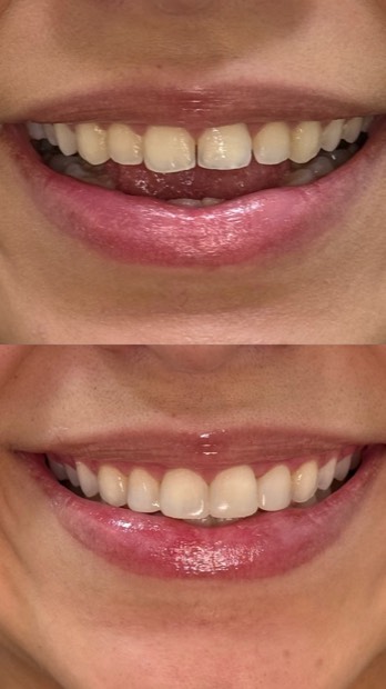 Antes e depois de facetas em resina, paciente da Brivva